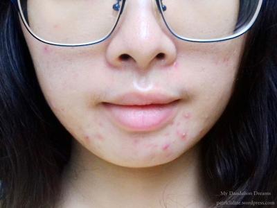 [Review] Natasha Skin Care Girl’s Secret Acne Treatment Set | My Dandelion Dreams